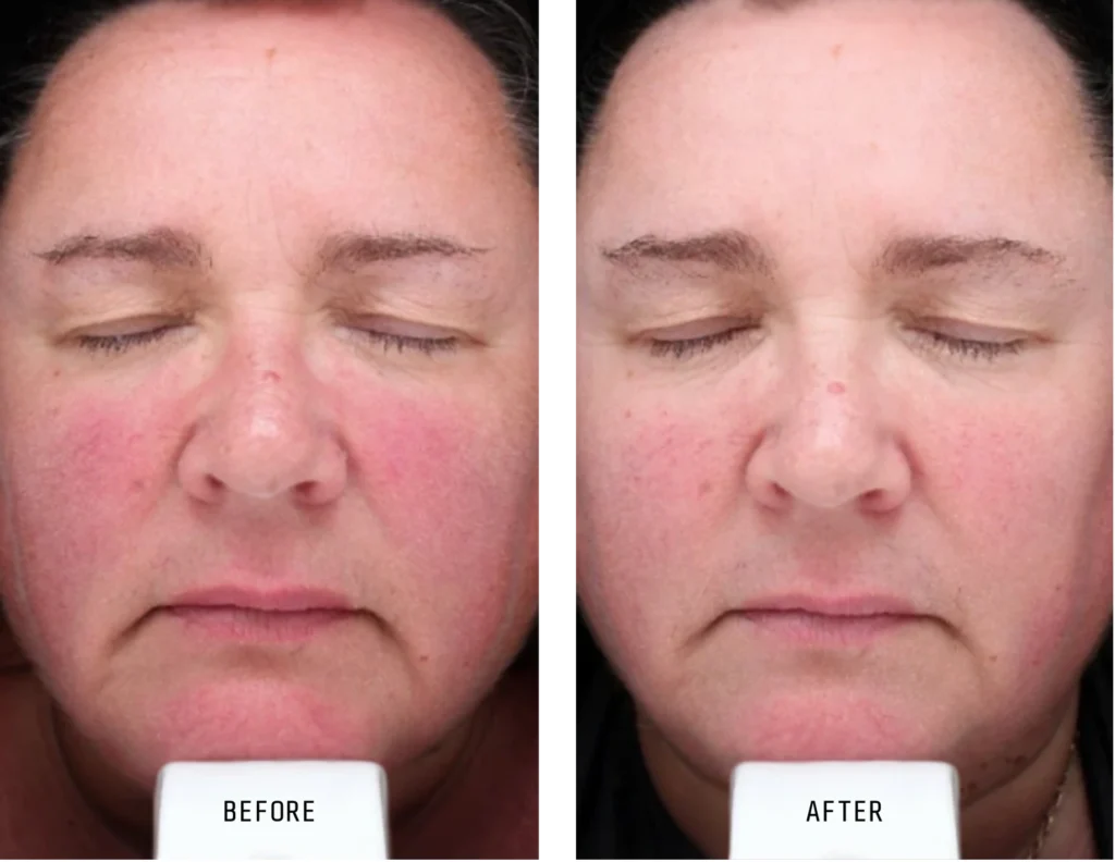 Before and after (1)